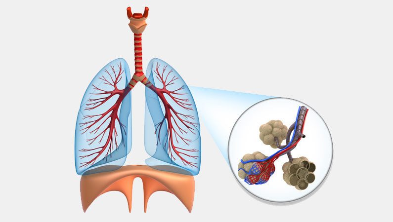 Chronisch obstruktive Bronchitis