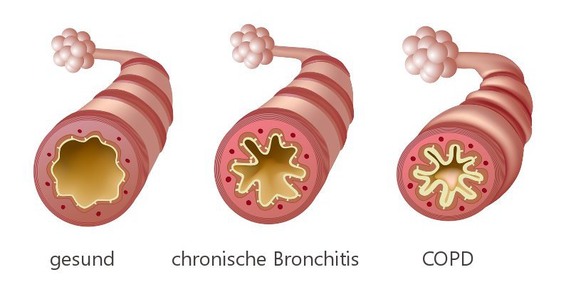 zunehmende Verengung der Bronchien bei chronischer Bronchitis und COPD